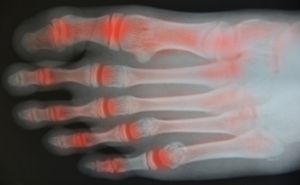 Stretches May Help Arthritic Feet