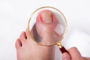 Ingrown Toenails and Prevention Strategies