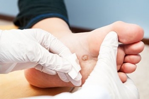 How Are Foot Warts Removed?