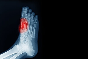 Big Toe Pain and Sesamoiditis